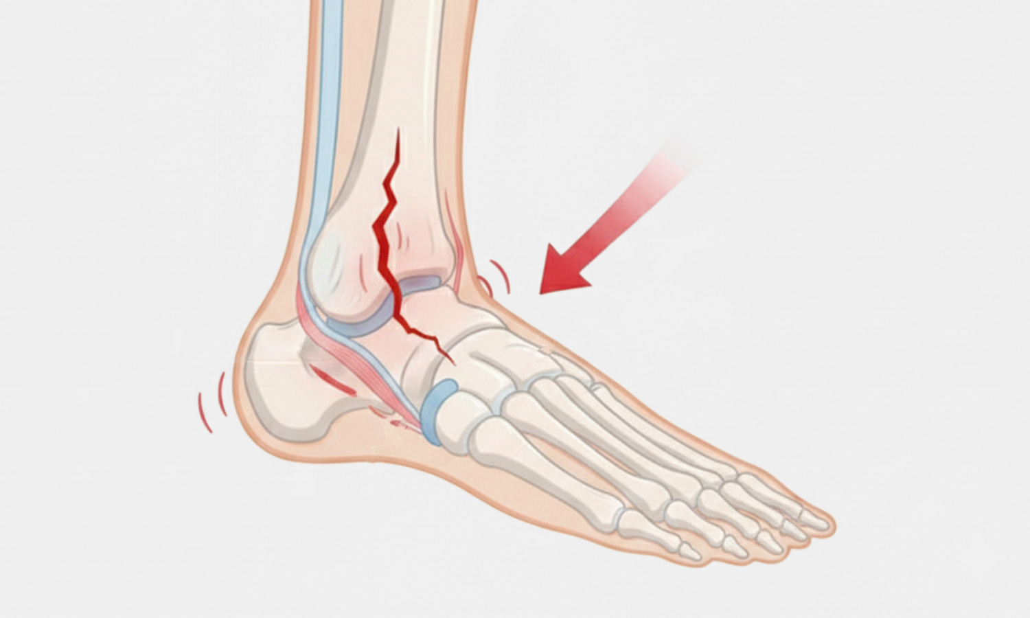 Ankle-fracture