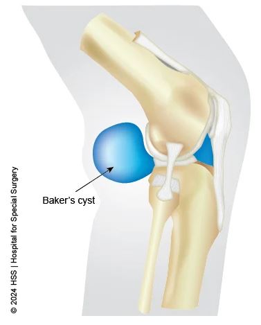 bakers cyst